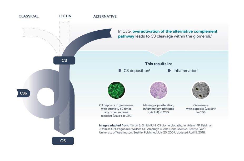 Image showing the mechanism of disease of C3G. In C3G, overactivation of the alternative complement pathway leads to C3 cleavage within the glomeruli. This results in C3 deposition and inflammation. C3 deposits in glomerulus with intensity ≥2 times any other immune reactant (via IF) in C3G. Mesangial proliferation, inflammatory infiltrates (via LM) in C3G. Glomerulus with deposits (via EM) in C3G.