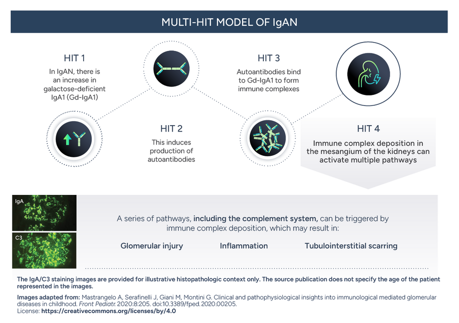 Image showing the multi-hit model of IgAN. In IgAN there is an increase in galactose-deficient IgA1 (Gd-IgA1). This induces production of autoantibodies. Autoantibodies bind to Gd-IgA1 to form immune complexes. Immune complex deposition in the mesangium of the kidneys can activate multiple pathways.